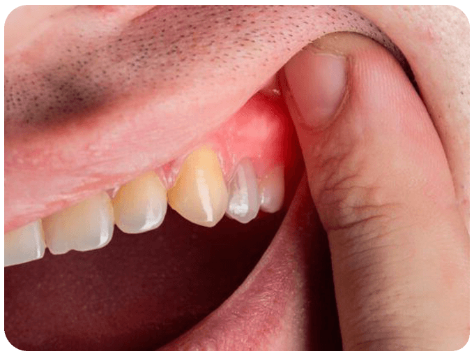 Root Canal Treatment - oral health