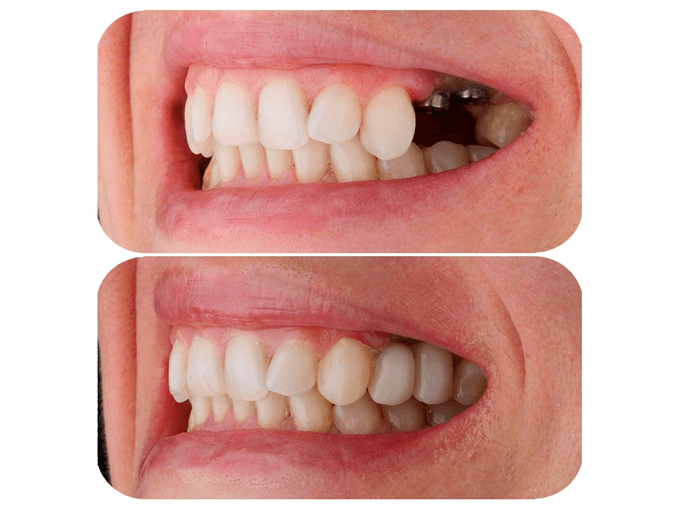 Dental Implants - Experiences of Patients