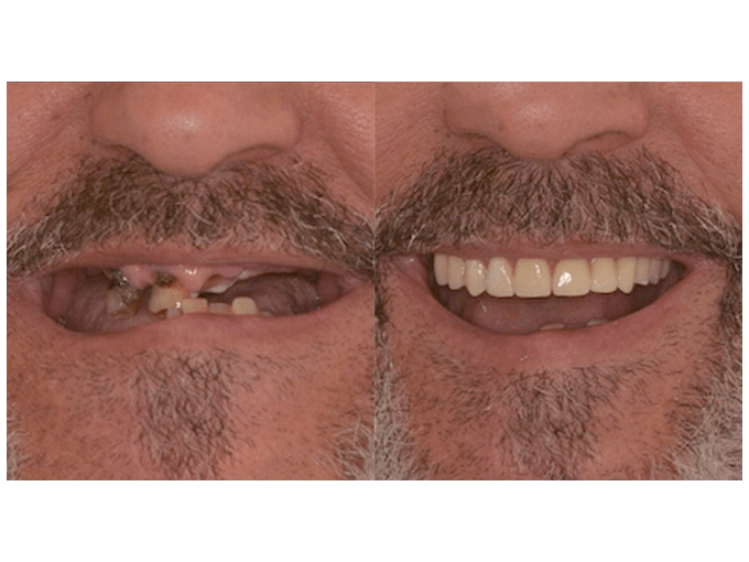 Dental Implants - Experiences of Patients