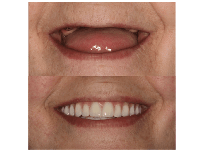 Dental Implants - Experiences of Patients