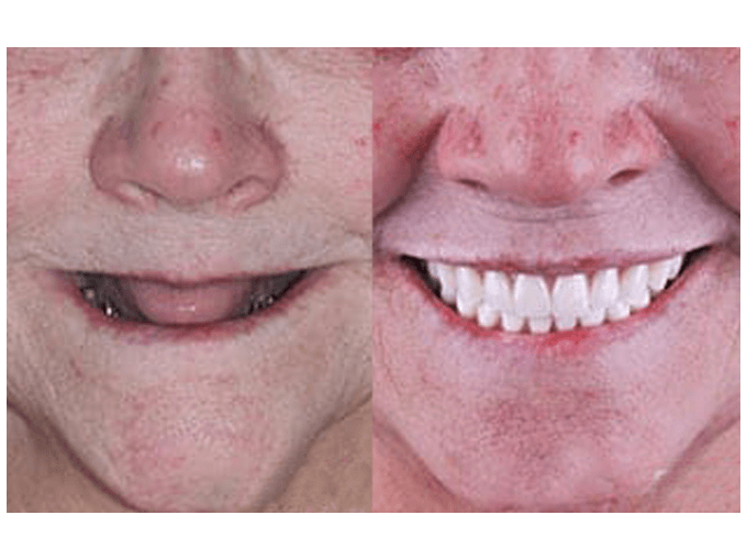 Dental Implants - Experiences of Patients