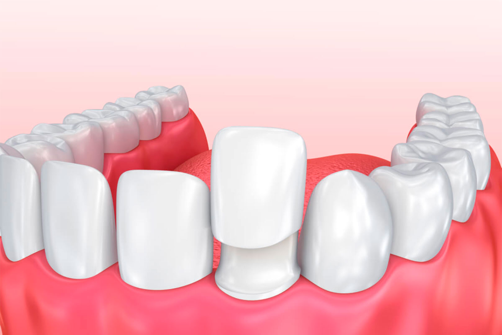 No-Prep-Veneers