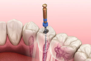 Root-Canals-Orlando