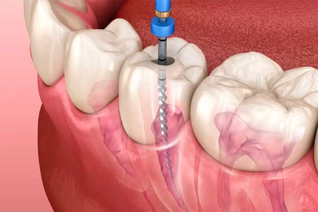 The-Root-Canal-Process-at-Nuvo-Dental