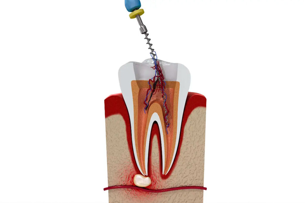 Understanding-the-Purpose-of-Root-Canal-Therapy