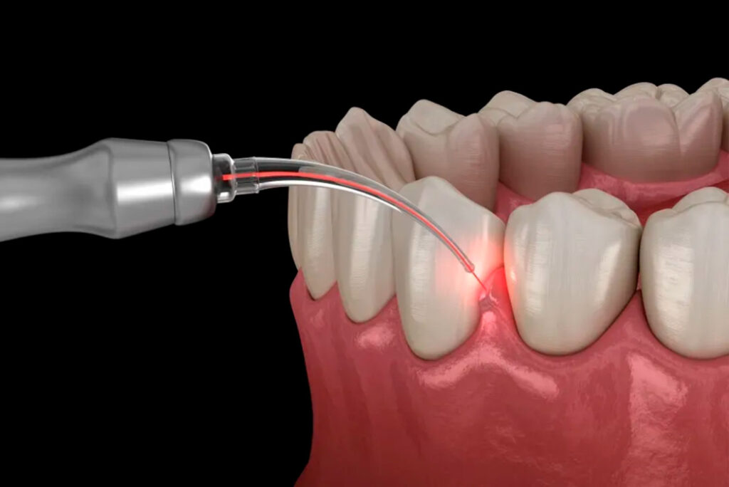 Gum Surgery