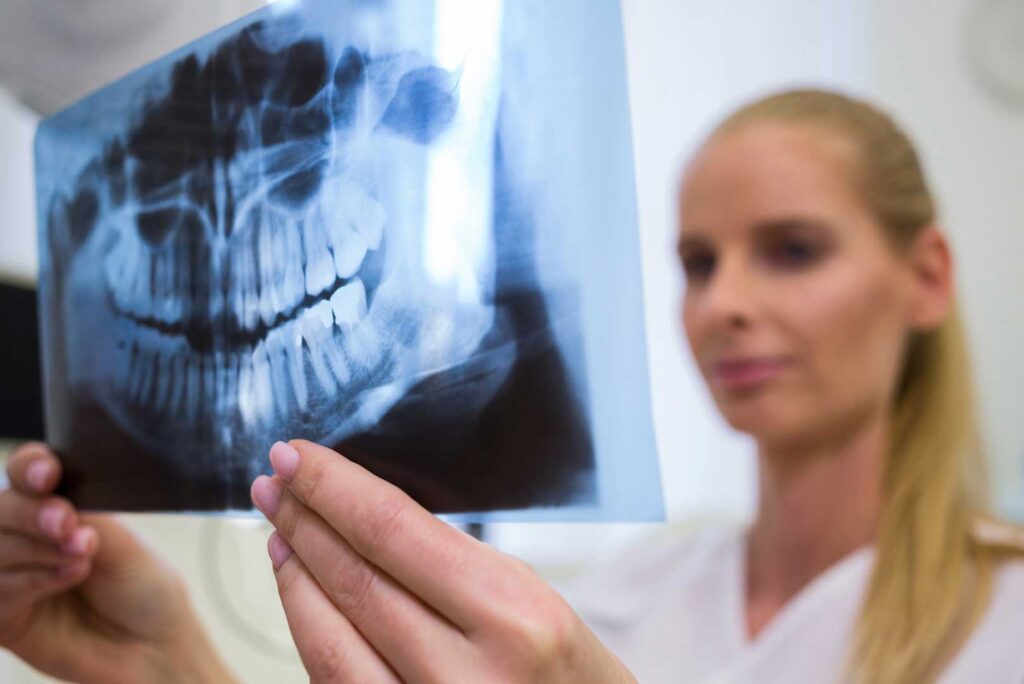 Wisdom Tooth Removal
