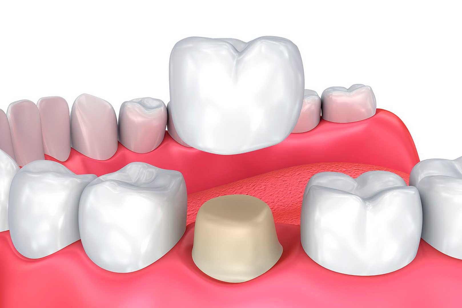 What Is a Dental Crown