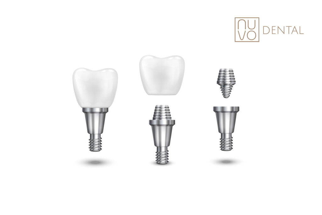Does Getting a Dental Implant Hurt