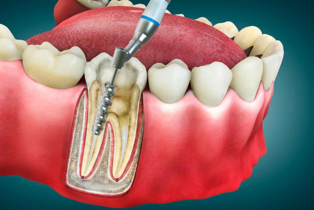 Signs You May Need a Root Canal