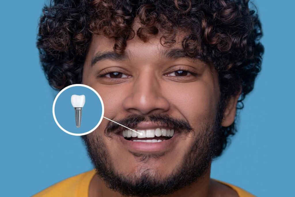 What to Expect During the Procedure of Dental Implant