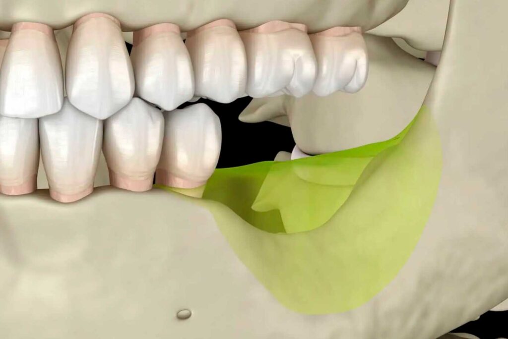 Tooth Loss and Bone Resorption