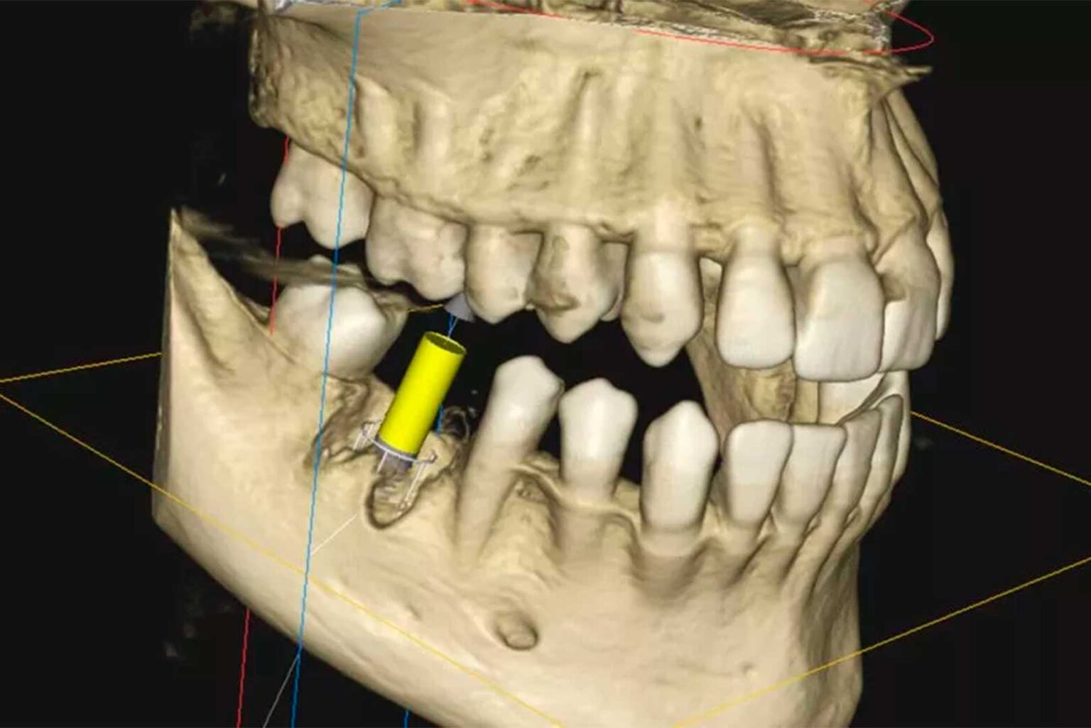 What is CBCT? A Complete Guide to 3D Dental Imaging at Nuvo Dental ...