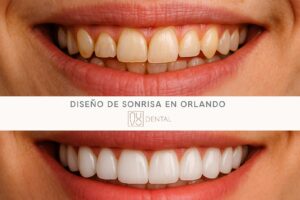 Diseño de Sonrisa en Orlando