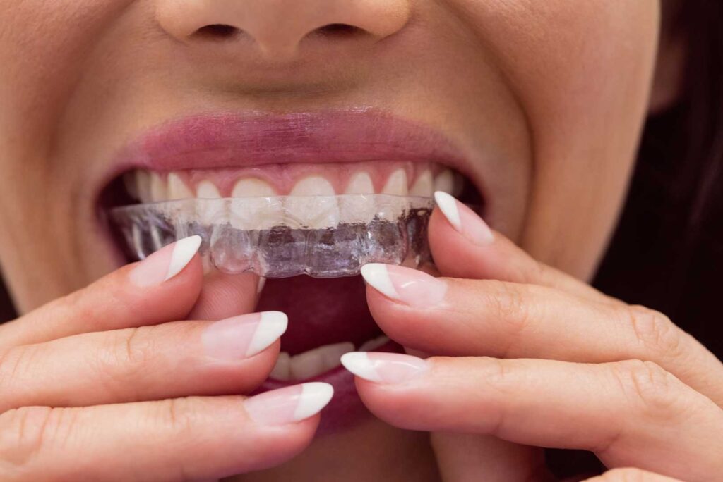 Duración del Tratamiento de Invisalign