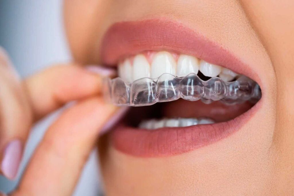 Ventajas del Invisalign sobre los Brackets Tradicionales