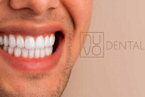 Dental Veneers in Vineland