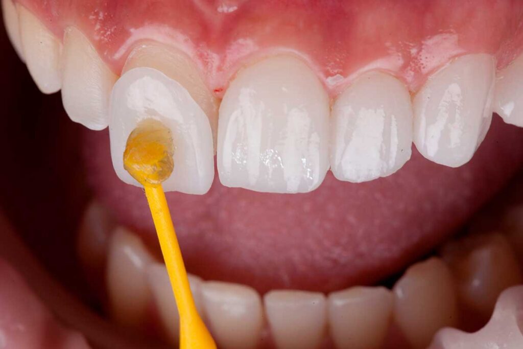 What Are Dental Veneers