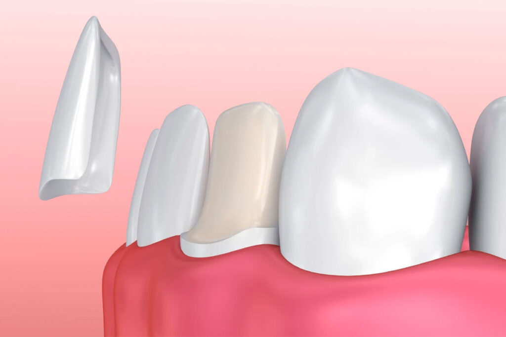 When Are Dental Veneers Recommended
