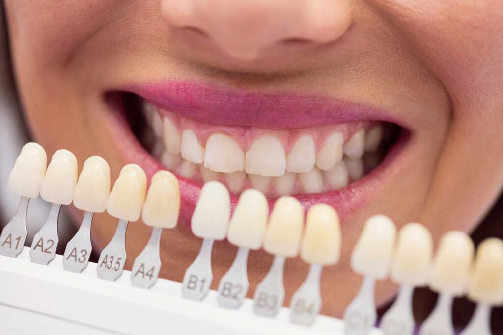 Why Choose Dental Veneers in Vineland