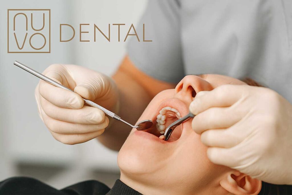 Extracción de las Muelas del Juicio