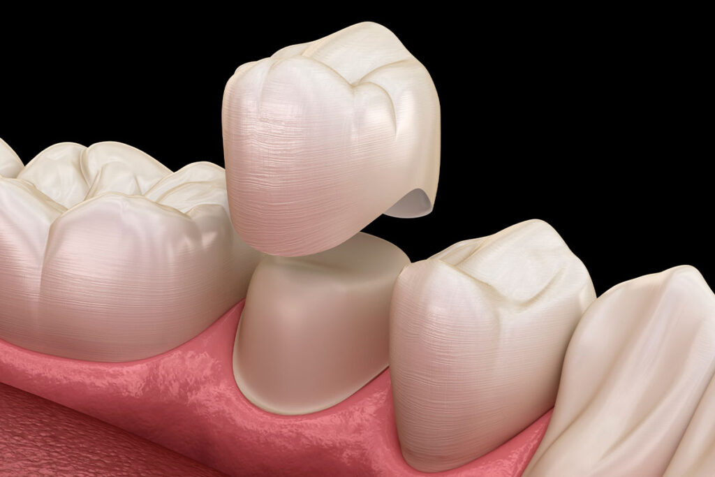 Dental Crowns and Partial Restorations