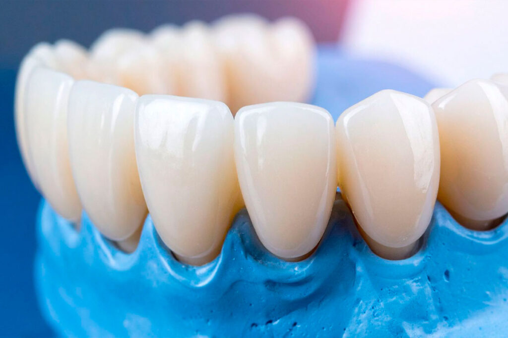 What Are Dental Clips