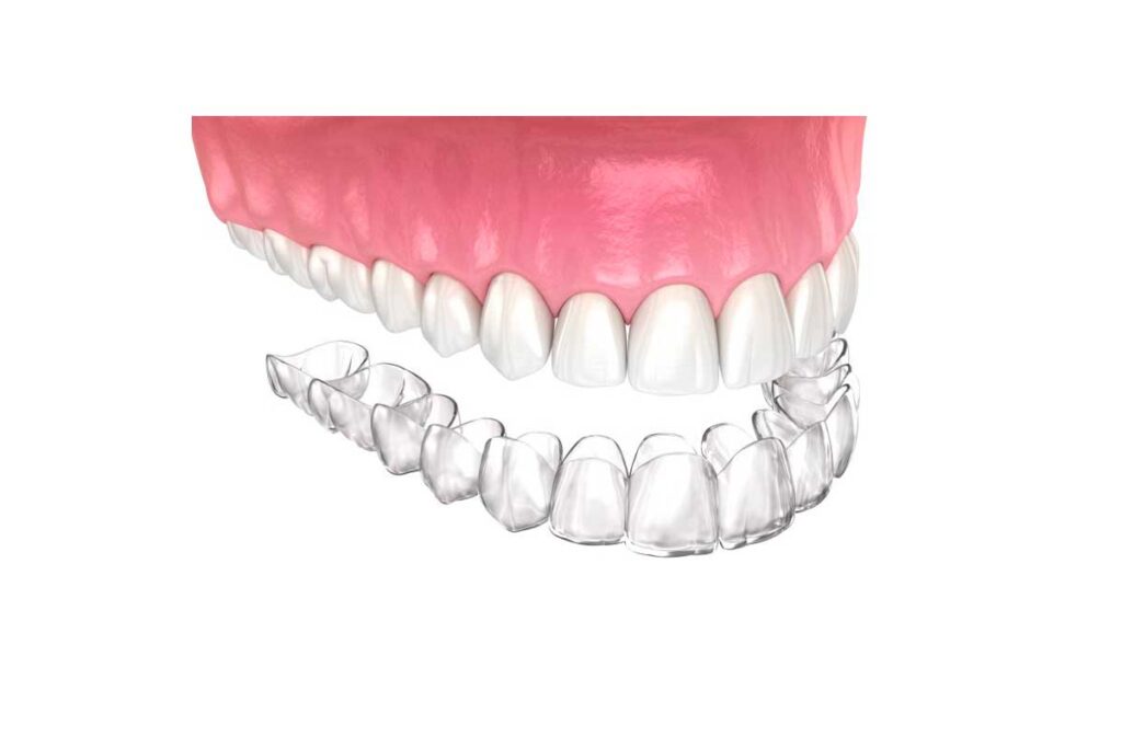 How Much Does Invisalign Cost in Nuvo Dental Compared to the Market