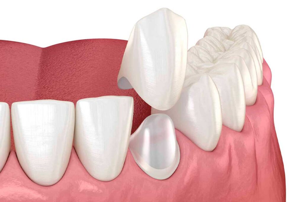 Qué-Son-las-Coronas-Dentales-y-los-Puentes-Dentales