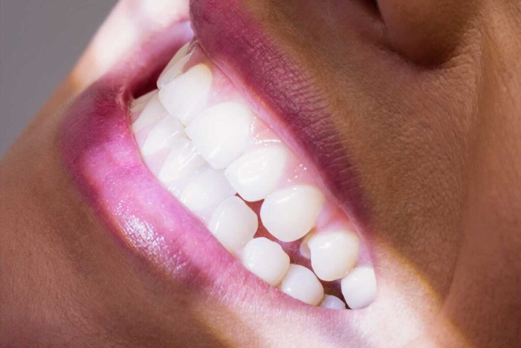 Qué es el Diseño de Sonrisa 2026