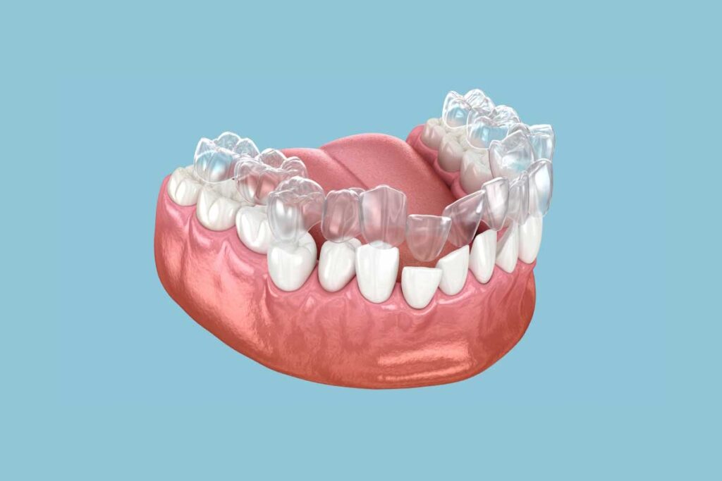 Why Invisalign Has Become a Popular Orthodontic Option