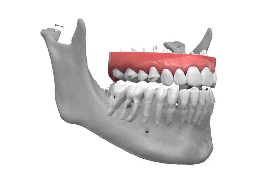 The Strong Connection Between CBCT and Dental Implants