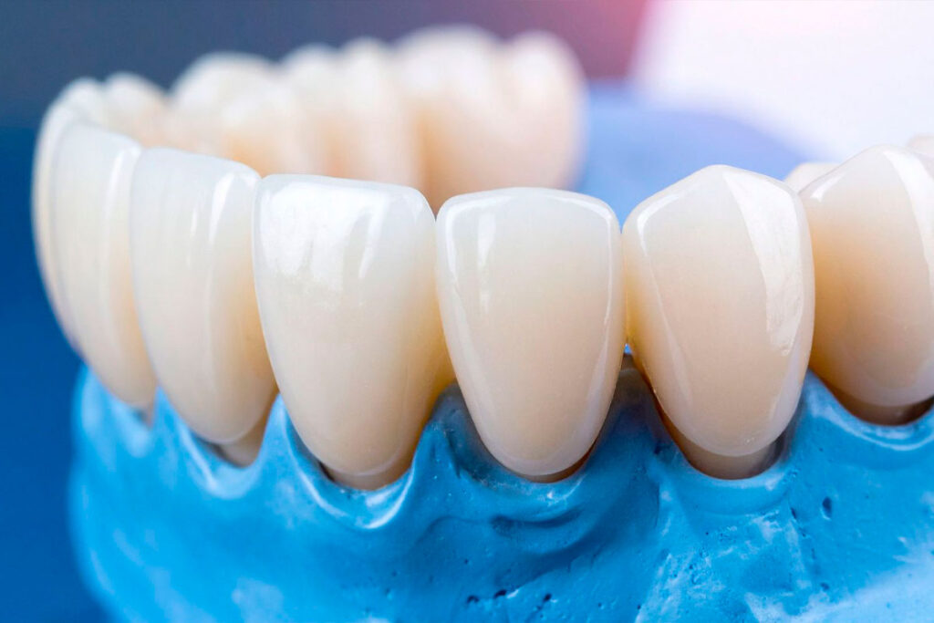 What-Are-Dental-Clips-for-Missing-Teeth