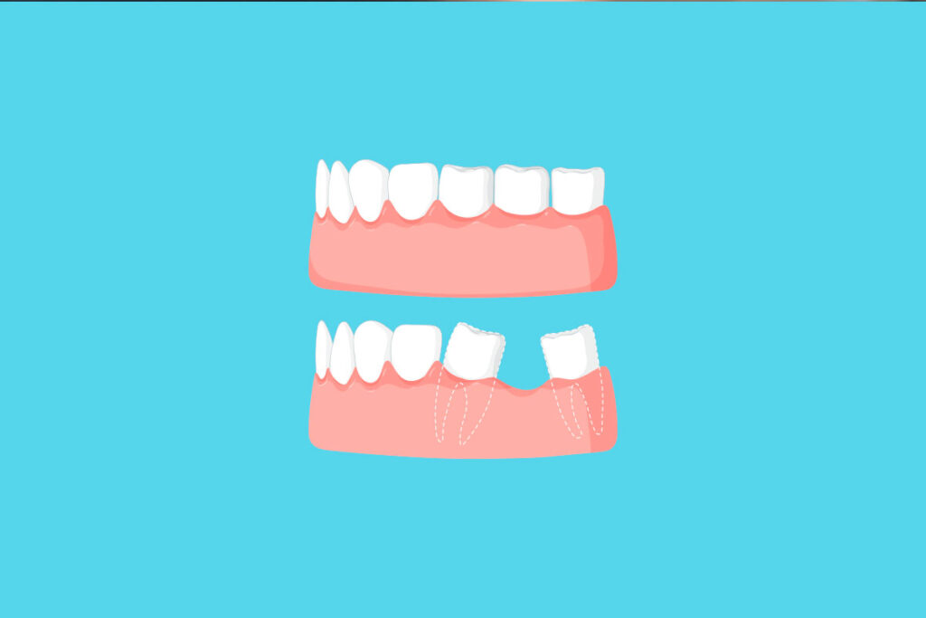 Why-Patients-Search-for-Dental-Clips-for-Missing-Teeth-Near-Me