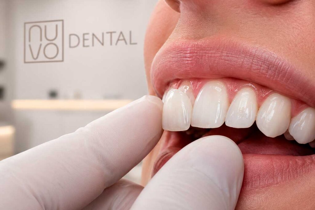 Porcelain Veneers in Florida