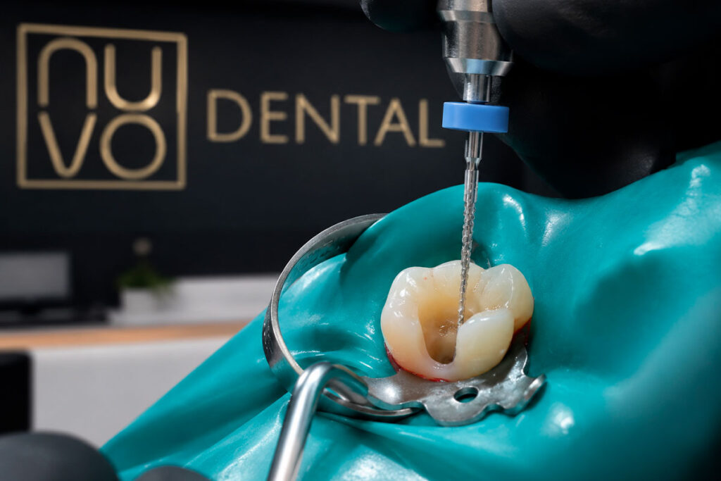 Root Canal Specialist in Florida