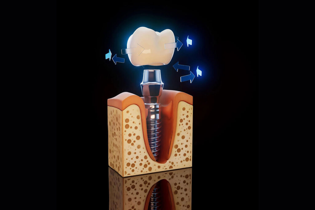 What-Does-Same-Day-Tooth-Replacement-Mean
