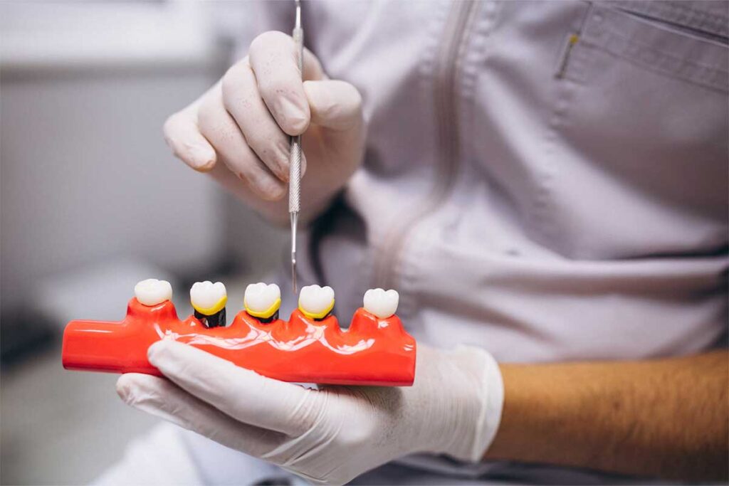 A Cracked Tooth Does Not Automatically Mean Losing It