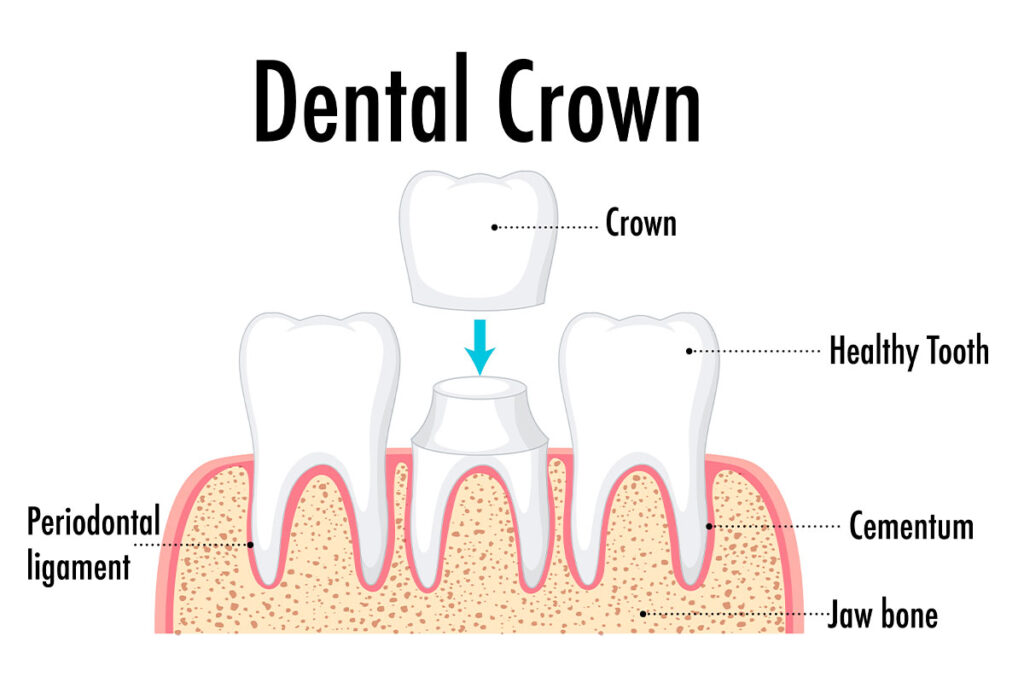 Can a Dental Crown Actually Save a Cracked Tooth