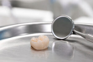 Cracked Tooth Repair in Orlando