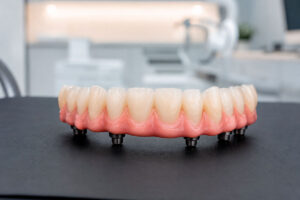 Full-Mouth-Dental-Implants-Near-Me