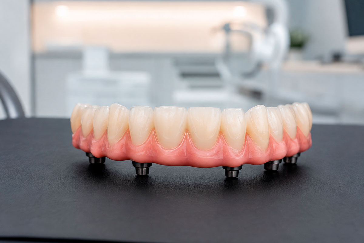 Full-Mouth-Dental-Implants-Near-Me