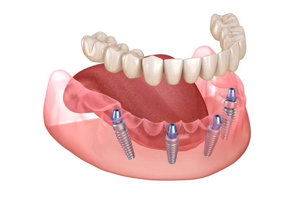 Full-mouth-rehabilitation-Philosophy