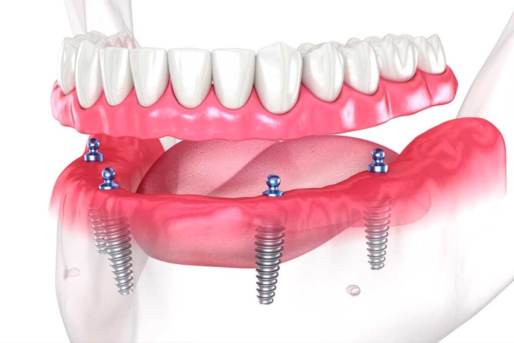 Who-Is-a-Candidate-for-Full-Mouth-Dental-Implants