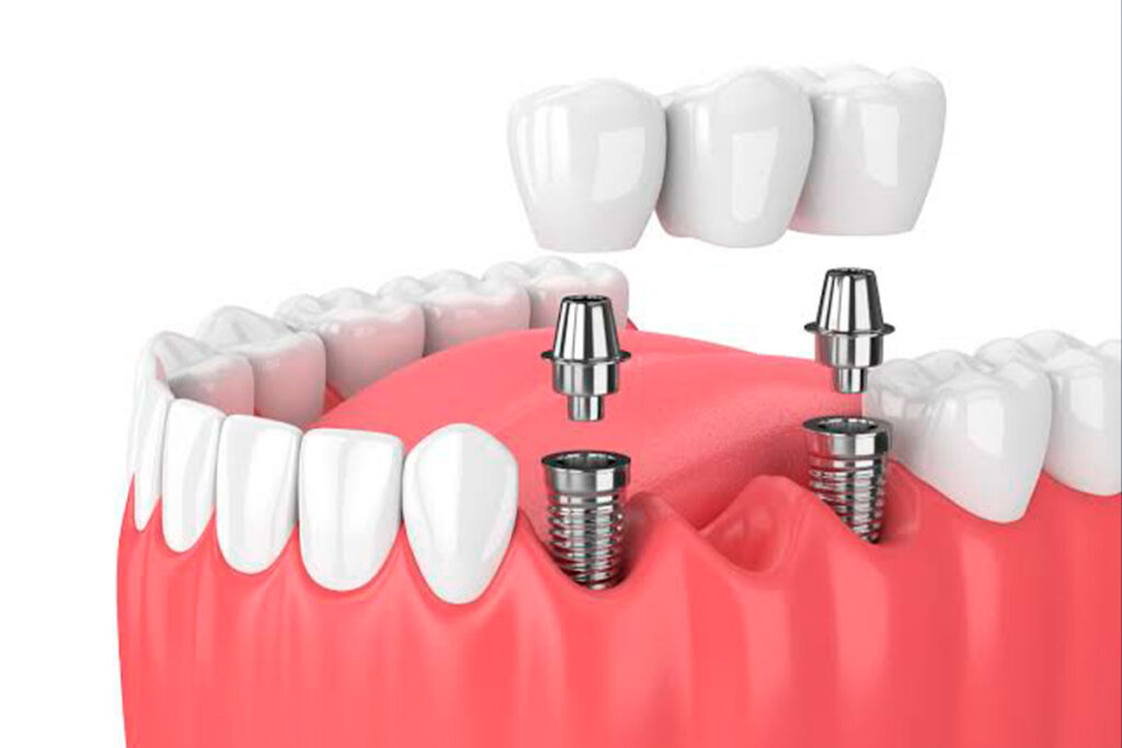Why-Choosing-the-Right-Implant-Provider-Matters
