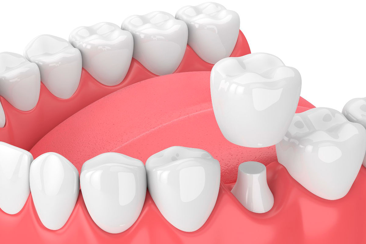 A Smile Makeover Should Begin Before Any Tooth Is Changed